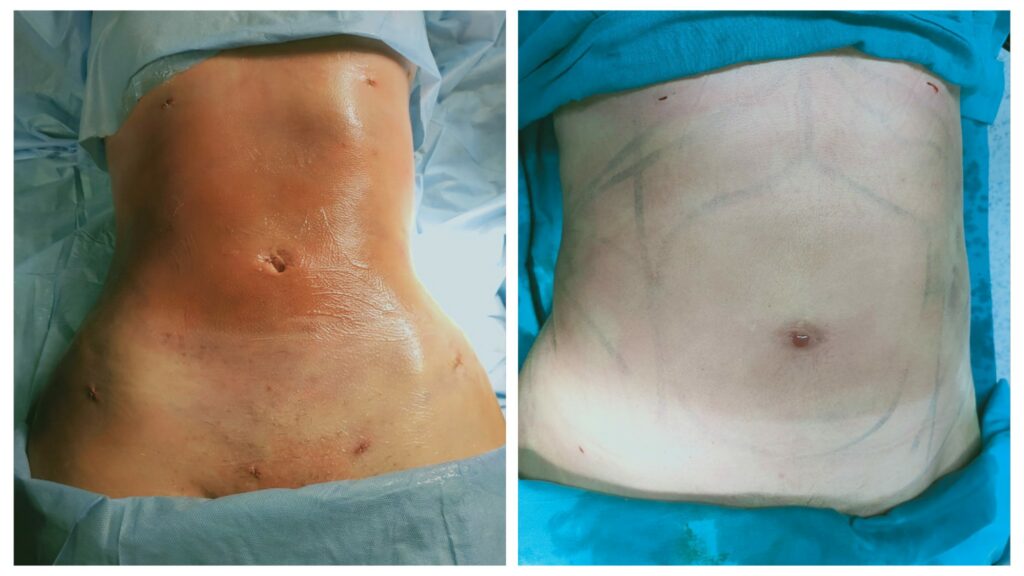 التخلص من دهون البطن مع إبراز السي كيرف